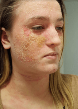3/4 profile of a woman with a skin condition
