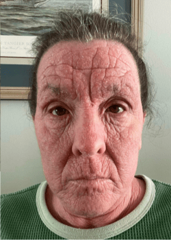 Selfie of a person with a skin condition