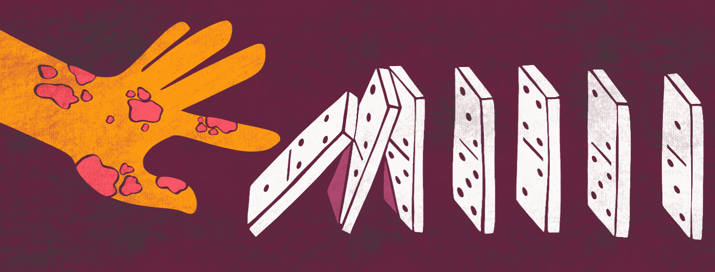 An animation of a hand with eczema flicking the start of a row of dominoes.