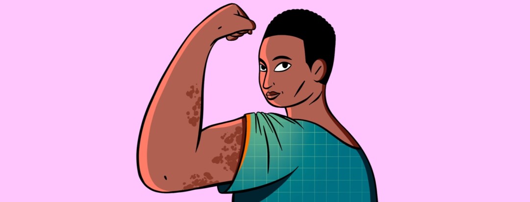 A woman flexes her arm with eczema on it
