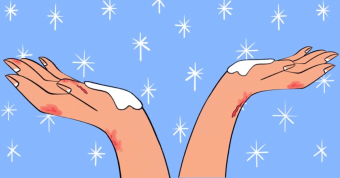 4 Ways To Managing Dry, Cracked Winter Rashes image