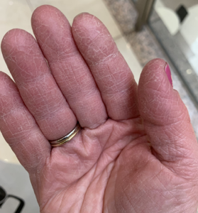 Eczema flare on a hand 