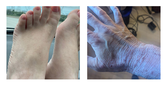 Discoloration on feet and back of hands