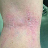 Flaky red skin behind the knee