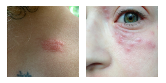 Clusters of blister on hand, back, and under the eye from left to right.