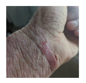 Peeling and splitting skin ( or Lichenification) on the wrist