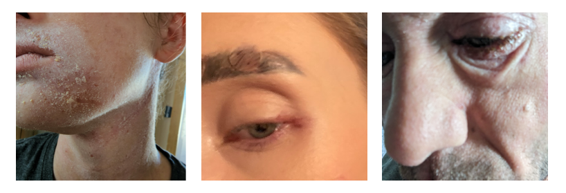 Signs of skin infection from left to right. Peeling flaking ashy skin, heat rash type splotches on the neck and jaw, red bumps and mucus around eye area, severe crusting around eye.